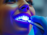 ¿Cada cuánto tiempo se puede hacer un blanqueamiento dental?