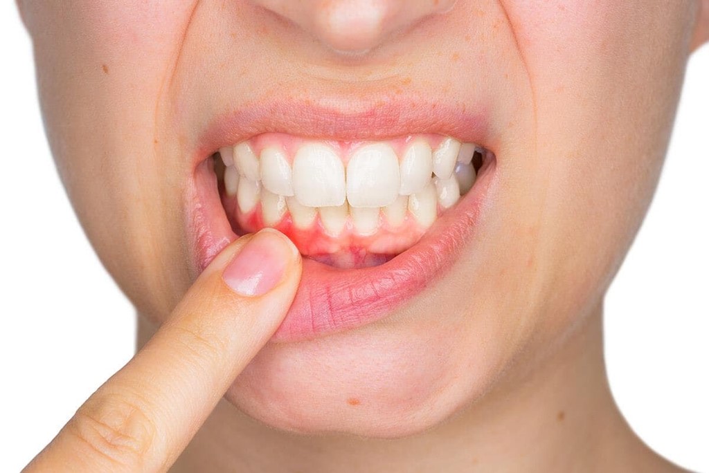 ¿Cómo se pueden prevenir las enfermedades periodontales?