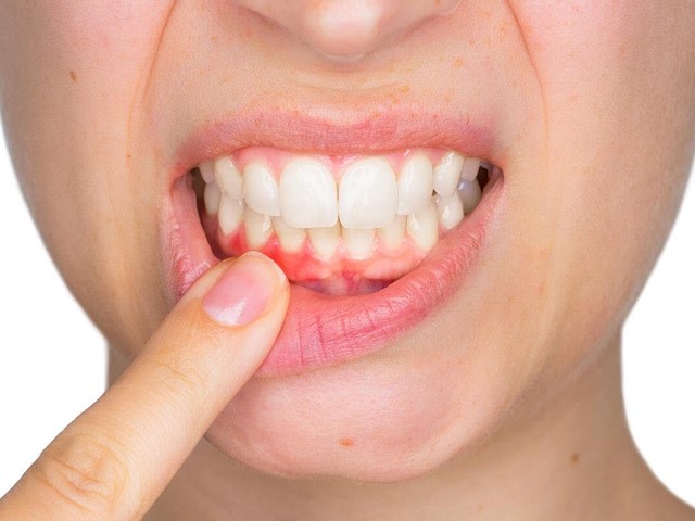 ¿Cómo se pueden prevenir las enfermedades periodontales?