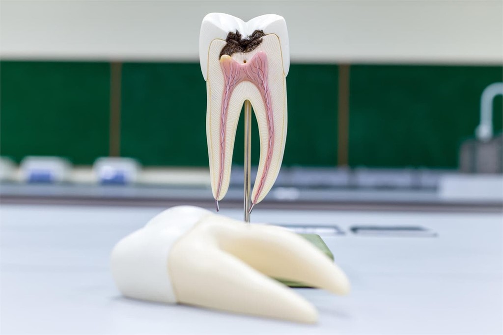 ¿Qué alternativa hay a una endodoncia?